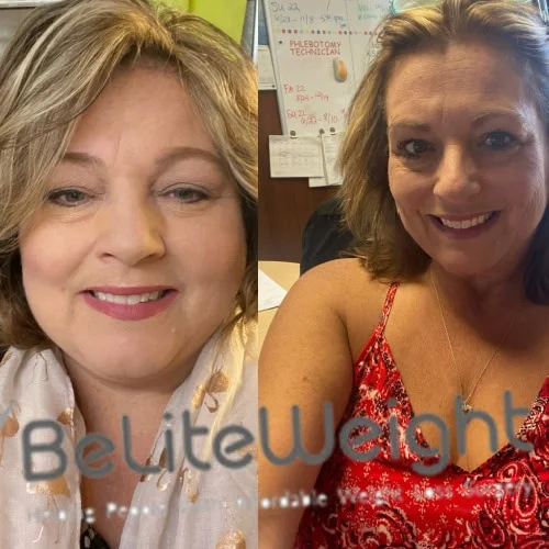 Weight Loss Surgery Before And After